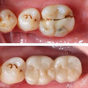result how long does a dental implant take winston hills nsw
