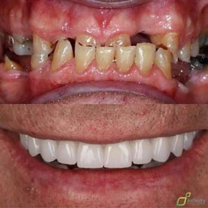 dental implant treatment guide winston hills