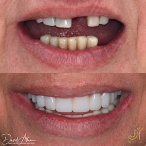 steps procedure teeth implant winston hills