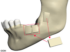 bone grafting