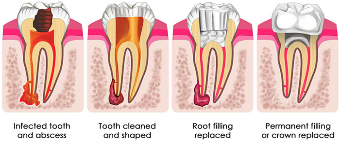 root canal