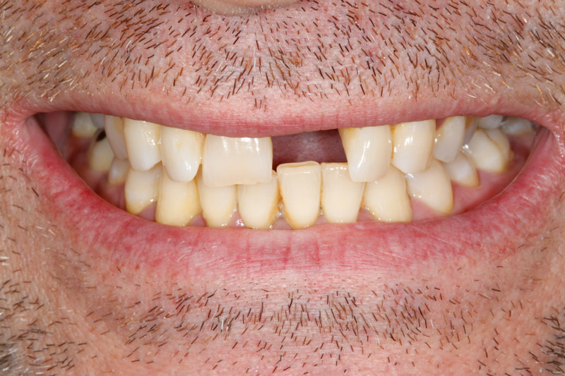 Dental Implant before