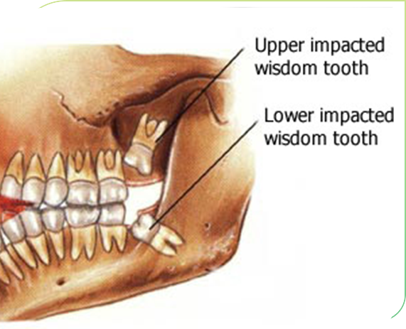 IDC-Impacted-tooth
