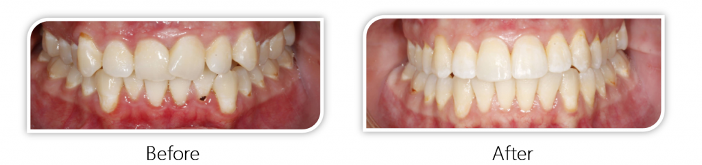 Before and after ortho case