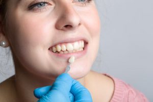types benefits dental veneers winston hills