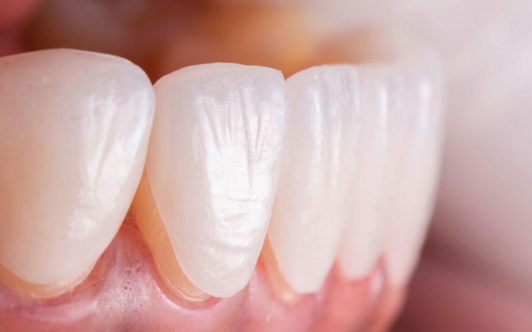 How Are Teeth Prepped for Veneers? A Comprehensive Guide