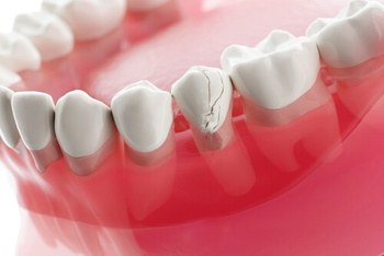 Veneers For Crooked Teeth front teeth winston hills