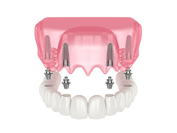 all 4 dental implants cost image winston hills