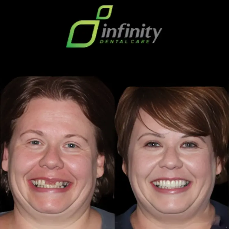 Dental Implants - Case 1- Infinity Dental Care 