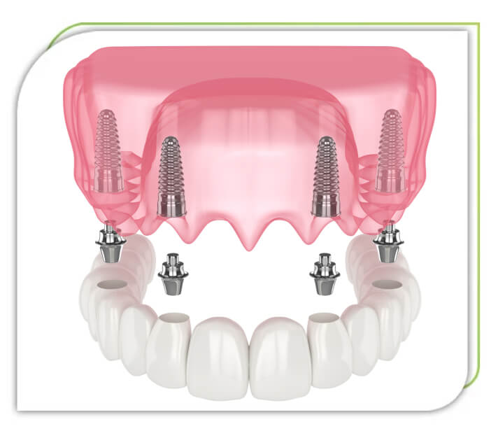 infinity dental care full dental implants
