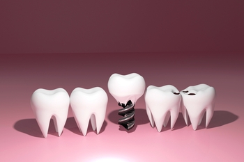 solo tooth implant costs winston hills