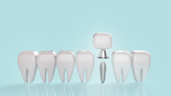dental implant abroad winston hills