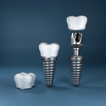 dental implant overseas winston hills