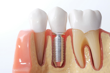 out of the country dental implant winston hills
