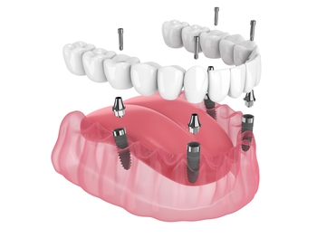 teeth implant price thailand winston hills