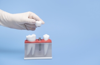 tooth implant cost abroad winston hills