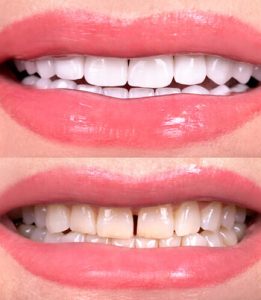 Do Veneers Ruin Your Teeth preparation