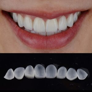 Do Veneers Ruin Your Teeth preparation