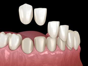 do veneers hurt teeth shells