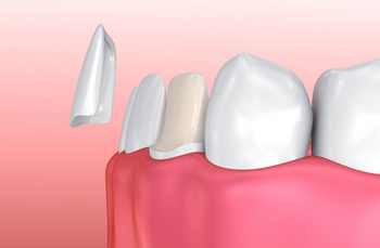 natural-looking-veneers application shells