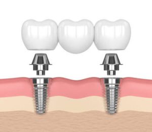 Dental Implants Vs Bridge comparison