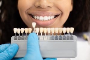 Do Veneers Protect Your Teeth prep