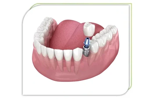 Dental-implant-Beyond-infinity-dental-care 