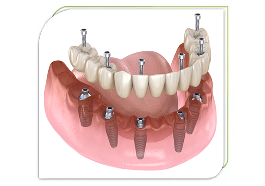 Teeth replace - BID