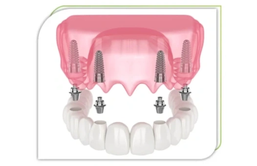 infinity-dental-care-full-dental-implants