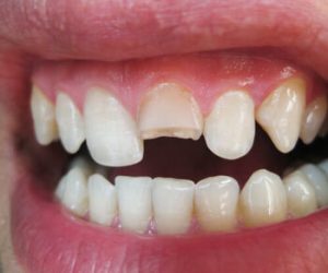 can you eat with veneers chip tooth