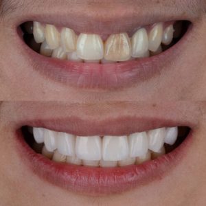 can you eat with veneers veneers benefit