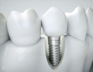 Dental-Implants-Cost-India-illustration