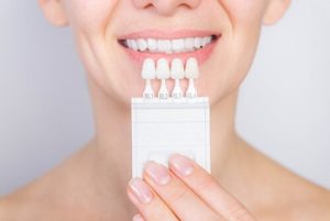 Braces vs Veneers benefits