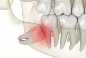 wisdom tooth pain impacted