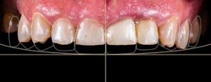 Root Canal Before and After decay