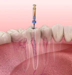 Root Canal Before and After procedure