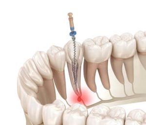 Root Canal Before and After treatment