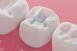 Tooth Sensitivity After a Filling procedure