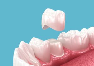 What Is A Dental Crown types
