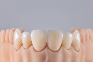 What Is A Dental Crown use