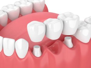 Dental Bridge Types use
