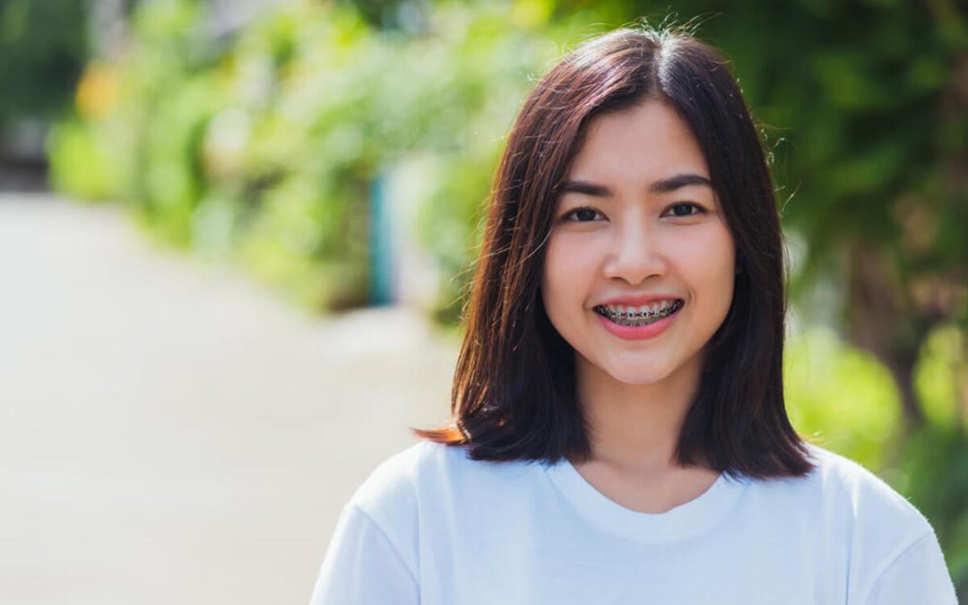 Are Braces Worth It? Here’s What You Really Need to Know