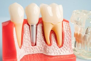 Dental Bone Graft Recovery implant