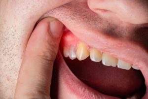 Root Canal Cost with Private Health Insurance abscess