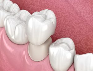 Root Canal Cost with Private Health Insurance crown