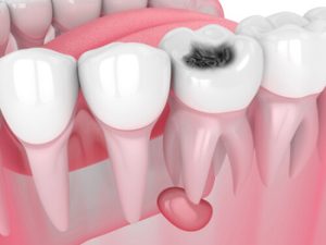 Root Canal Recovery Time infection