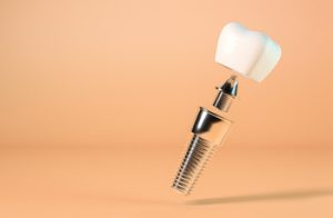 dental implant components parts