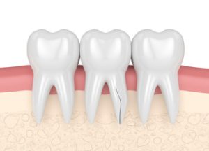 does root canal hurt check
