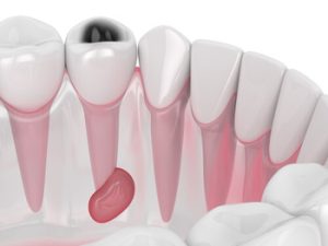 does root canal hurt infection