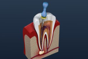 does root canal hurt procedure